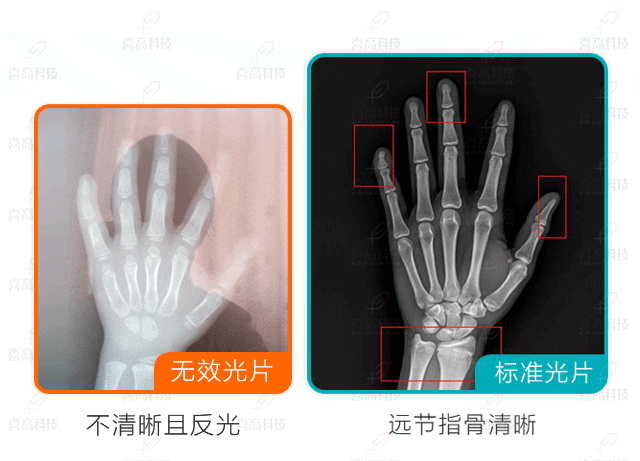 网上问诊需要提供什么样的骨龄片？.gif