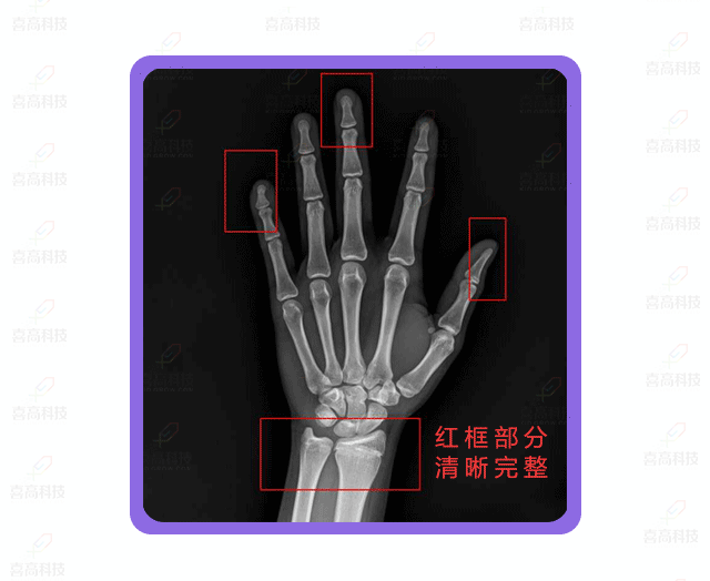 如何拍好手腕部X光片？怎样做好防护？.gif