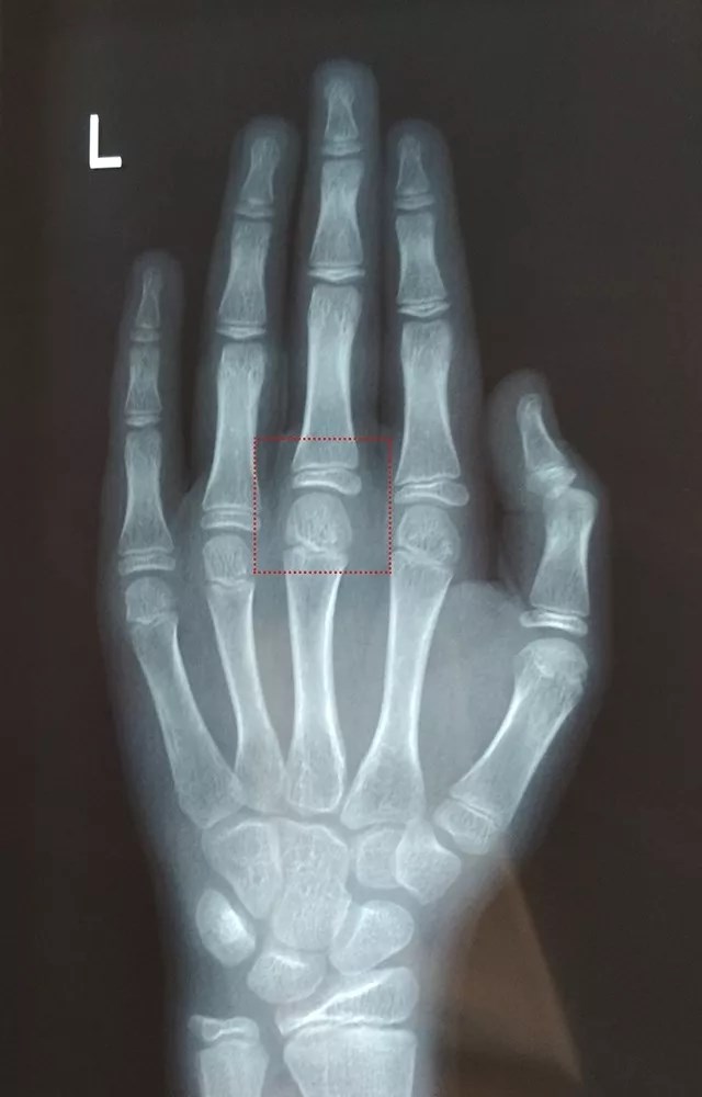 确保片子上的文字是正的(也可通过手指向上,大拇指在右侧来判断),然后